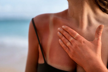 Aloe vera și uleiul de cocos te pot ajuta după arsuri solare – dar doar dacă le folosești la momentul potrivit