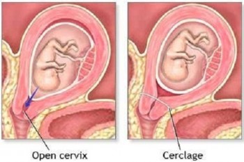 Cerclajul colului uterin - riscurile și beneficiile acestei proceduri