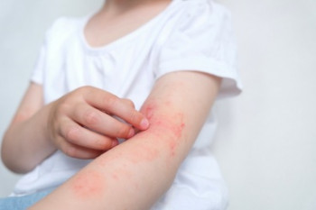 Dermatita atopică: mai mult decât o ”simplă afecțiune a pielii”