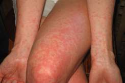 Scarlatina la gravide – riscuri pentru fiecare trimestru