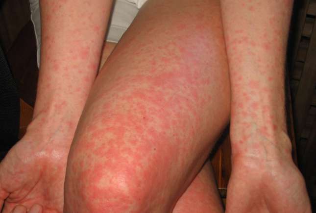 Scarlatina la gravide – riscuri pentru fiecare trimestru