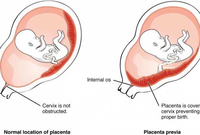 Sarcina joasă, adică placenta previa. Tot ce trebuie să știi!