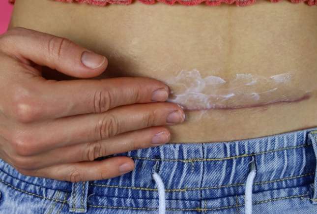 Caz extrem de rar. O femeie a născut până la 40 de ani nouă copii, toţi prin cezariană