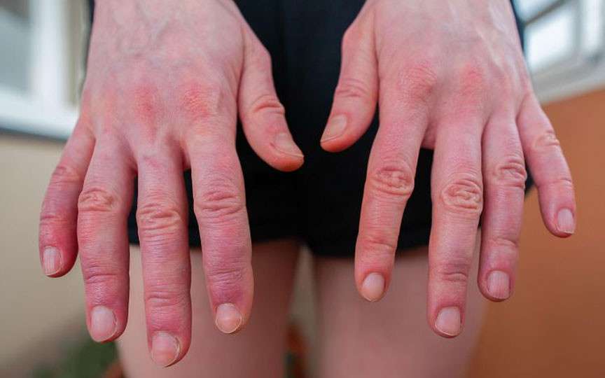Femeie de 30 de ani, prizonieră în propria piele: diagnosticată cu boala arderii după sarcină