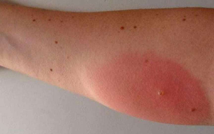 Mușcătura de tăun: De ce este mai dureroasă decât cea de țânțar și cum o tratezi corect