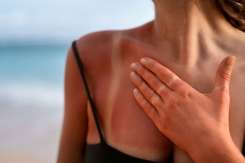 Aloe vera și uleiul de cocos te pot ajuta după arsuri solare – dar doar dacă le folosești la momentul potrivit