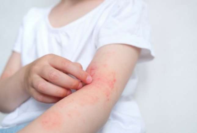 Dermatita atopică: mai mult decât o ”simplă afecțiune a pielii”