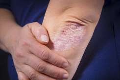 Psoriazis: cauze, simptome, tratament