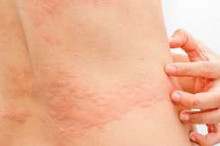 Medic alergolog: Urticaria la frig este însoțită de o puternică senzație de mâncărime