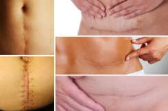Medic obstetrician-ginecolog despre reluarea vieții sexuale după operația cezariană