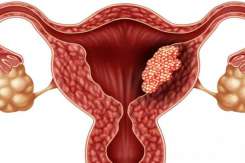 10 mituri demontate despre cancerul de col uterin – ucigașul a peste 300.000 de femei din întreaga lume