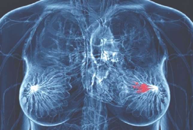 Cancerul mamar ocupă primul loc în morbiditatea prin tumori maligne la femei. 1000 de cazuri noi înregistrate anual în Moldova