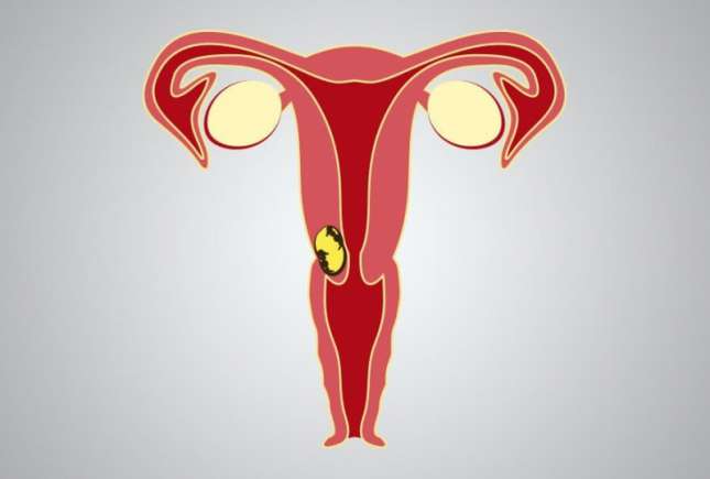 Cancer vaginal: factori de risc și simptome