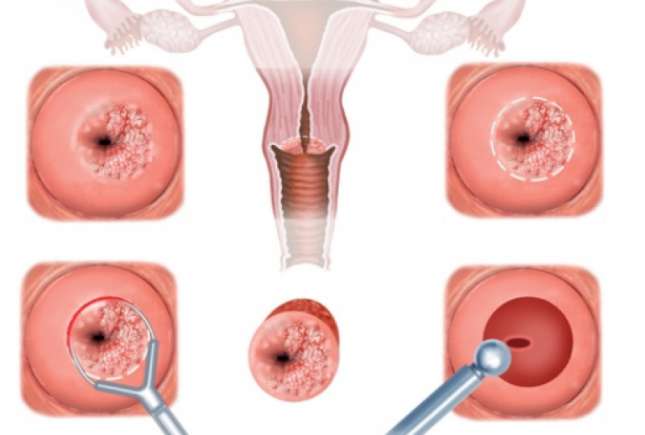 Rana pe col uterin nu dă dureri, dar poate duce la cancer