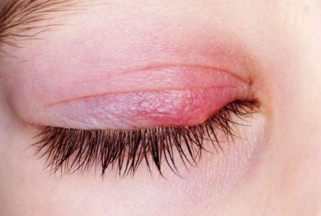 Cum se tratează ulciorul, infecția oculară care apare de la mic la mare