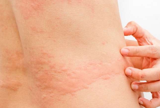 Medic alergolog: Urticaria la frig este însoțită de o puternică senzație de mâncărime