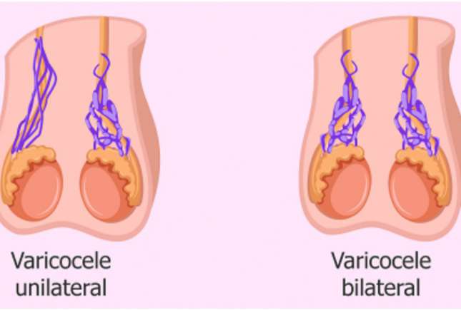Varicocelul  - o cauză frecventă de infertilitate