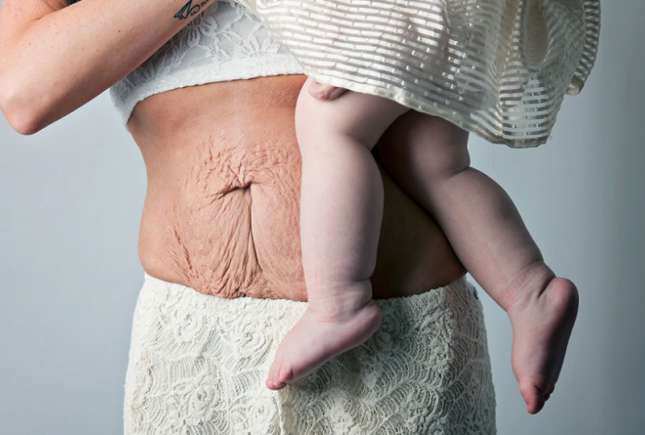 Medic dermatolog despre pielea lăsată după sarcină - soluții care funcționează