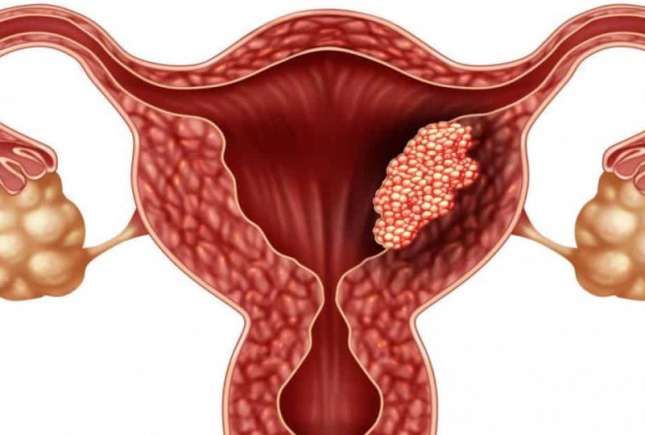 10 mituri demontate despre cancerul de col uterin – ucigașul a peste 300.000 de femei din întreaga lume