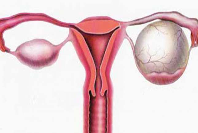 Chisturile ovariene: 13 mituri spulberate de medicul ginecolog