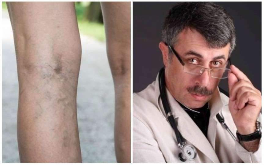Evghenii Komarovskii are sfaturi și pentru sănătatea mamelor: profilaxia venelor varicoase
