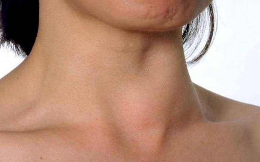 Cel mai evident simptom al lipsei de iod din organism - cauza bolilor de tiroidă