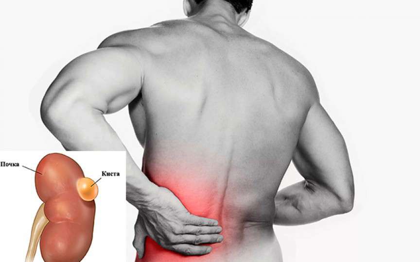 Chistul renal: simptome și cauze
