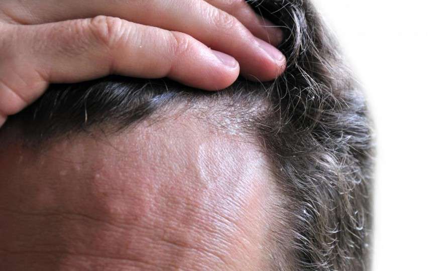 Ce este dermatita seboreică și cum se tratează