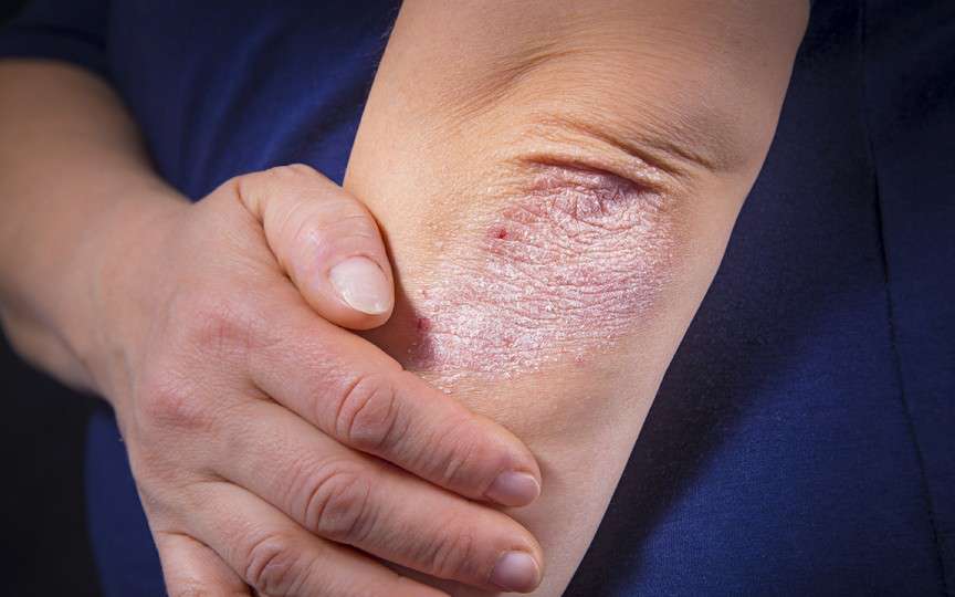 Psoriazis: cauze, simptome, tratament
