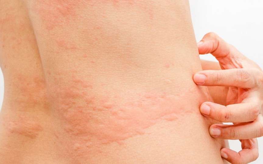 Medic alergolog: Urticaria la frig este însoțită de o puternică senzație de mâncărime