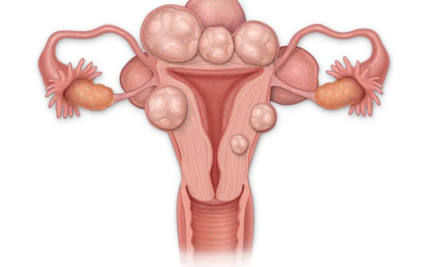 Medic: Aproape 40% dintre femeile de până la 35 de ani dezvoltă un fibrom uterin