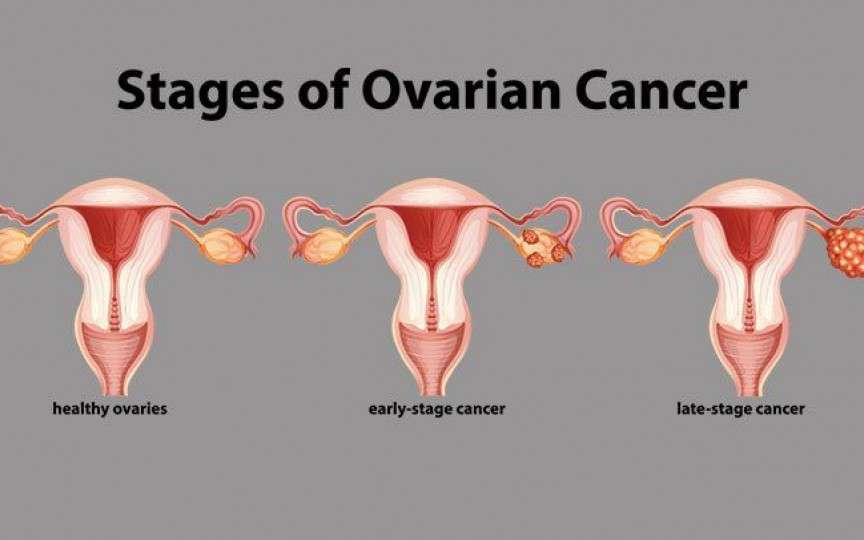 7 simptome ale cancerului ovarian