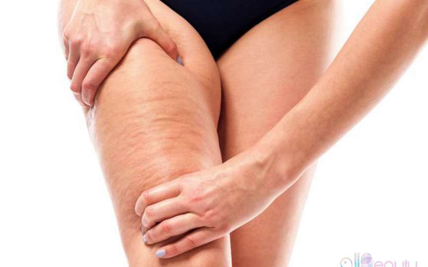 Celulită și vergeturi? Trucuri, dietă și exerciții care le combat