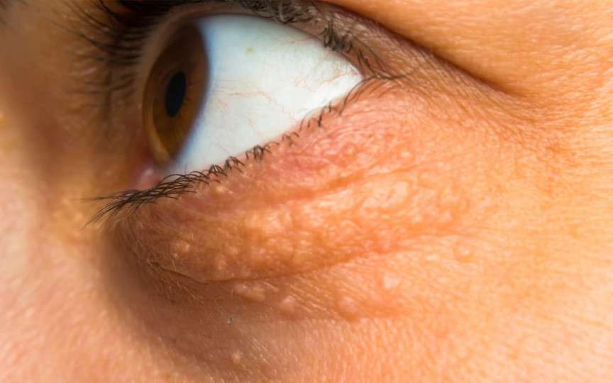 Semne în jurul ochilor care pot indica un colesterol crescut: ce să urmărești
