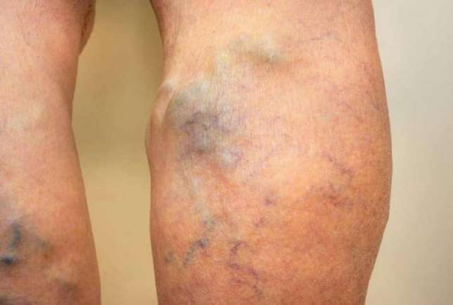 Suferi de varice? Iata 4 remedii naturale prin care poți trata acasă venele varicoase