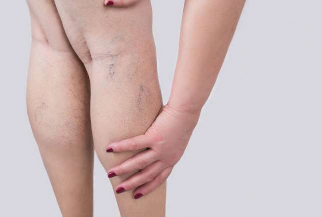 Cum să previi apariția varicelor: Sfaturi eficiente pentru sănătatea picioarelor tale