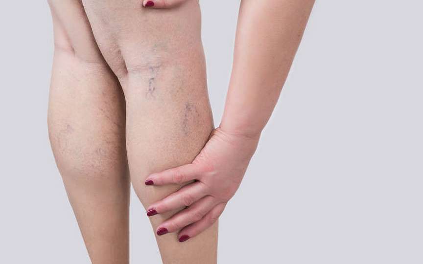 Cum să previi apariția varicelor: Sfaturi eficiente pentru sănătatea picioarelor tale