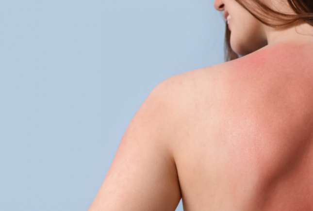 Arsuri solare? 5 ponturi să te refaci rapid