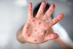 În Israel a murit de rujeolă o fetiță de 1,5 ani. Liderii religioși au făcut apel la părinți să-și vaccineze copiii