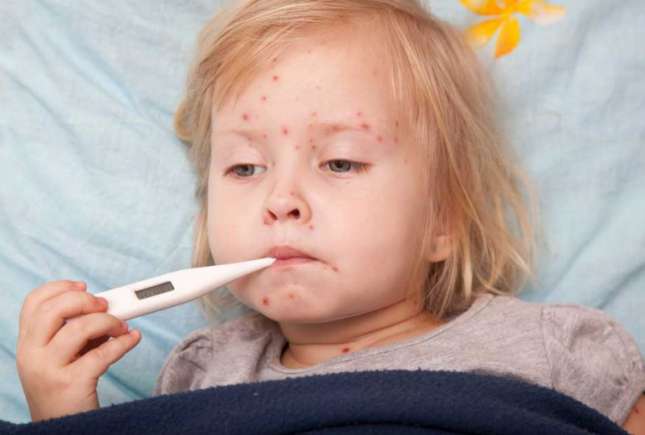 Rujeola a trecut Prutul? Află care sunt simptomele infecției!