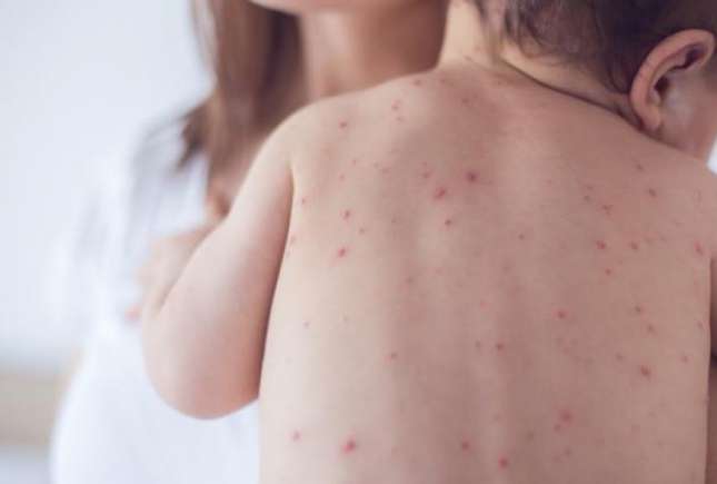 Informații utile de la pediatri despre bolile copilăriei – rujeolă, varicelă, rubeolă, scarlatină