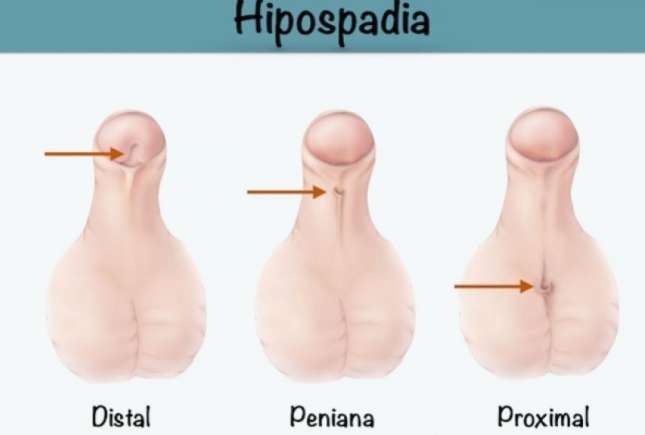 Medic chirurg pediatru despre copilul cu hipospadias și tratamentul chirurgical
