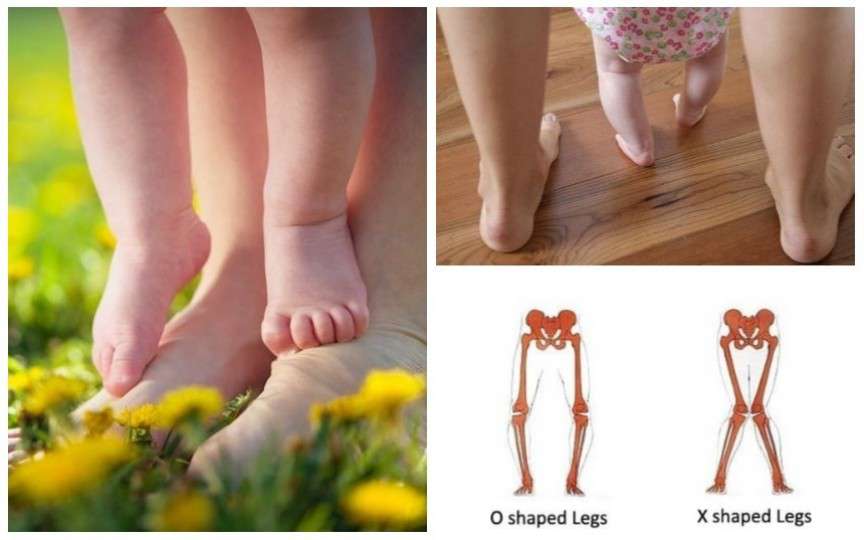 5 tulburări de mers la copii. Când trebuie să mergeți la specialist