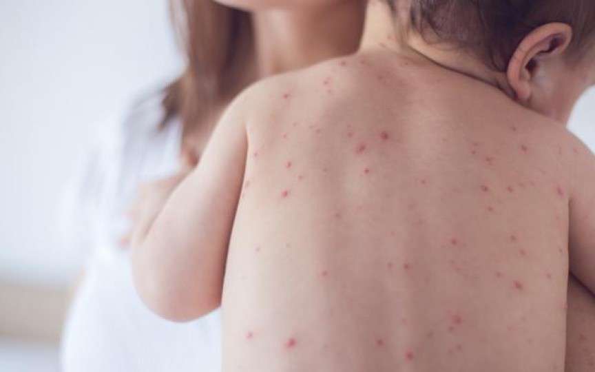 Informații utile de la pediatri despre bolile copilăriei – rujeolă, varicelă, rubeolă, scarlatină
