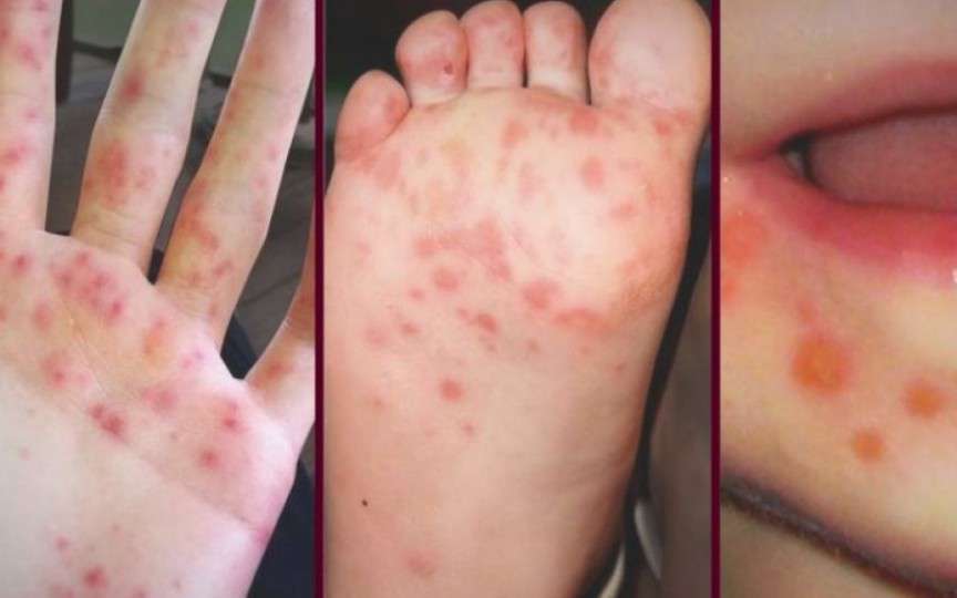 Boala mână-picior-gură: simptome și tratament
