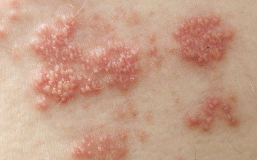 Zona Zoster: cauze, simptome, tratament, prevenţie