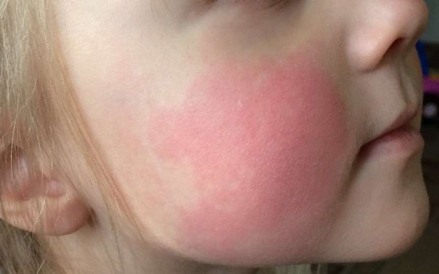 Eritemul infecțios la copii – o boală extrem de contagioasă. Cum se manifestă!