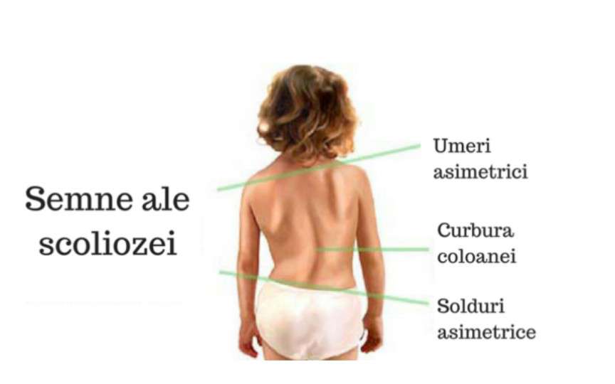 3 exerciții fizice care pot corecta scolioza la copii