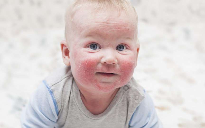 Dermatita atopică: 8 întrebări și răspunsuri despre una dintre cele mai frecvente afecțiuni