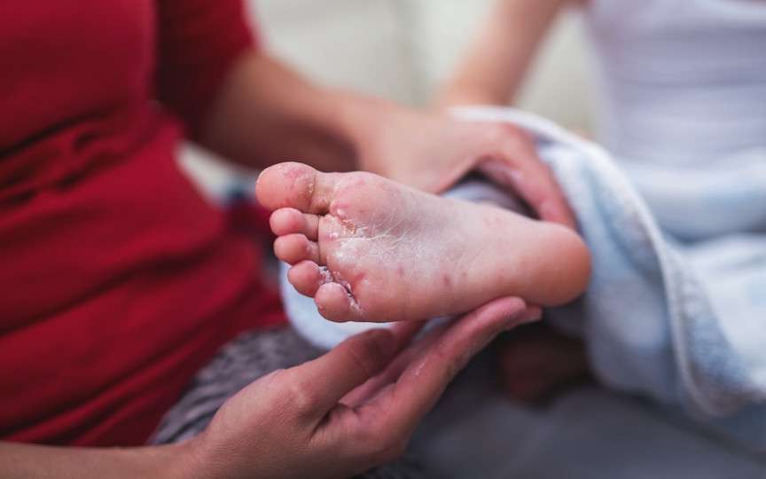 Copilul tău are boala gură-mână-picior? Iată ce ne sfătuiește medicul specialist